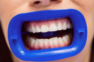 woman with dental equipment in mouth