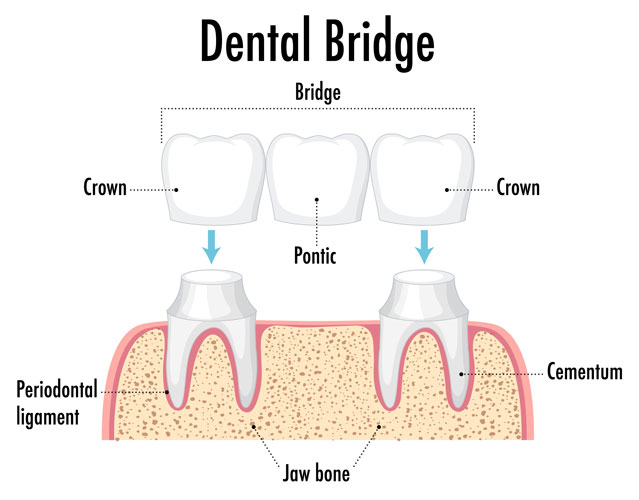 dental crown picture
