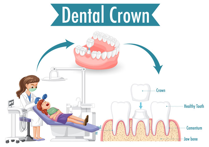 dental crown procedure
