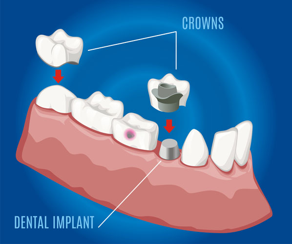 dental implant 